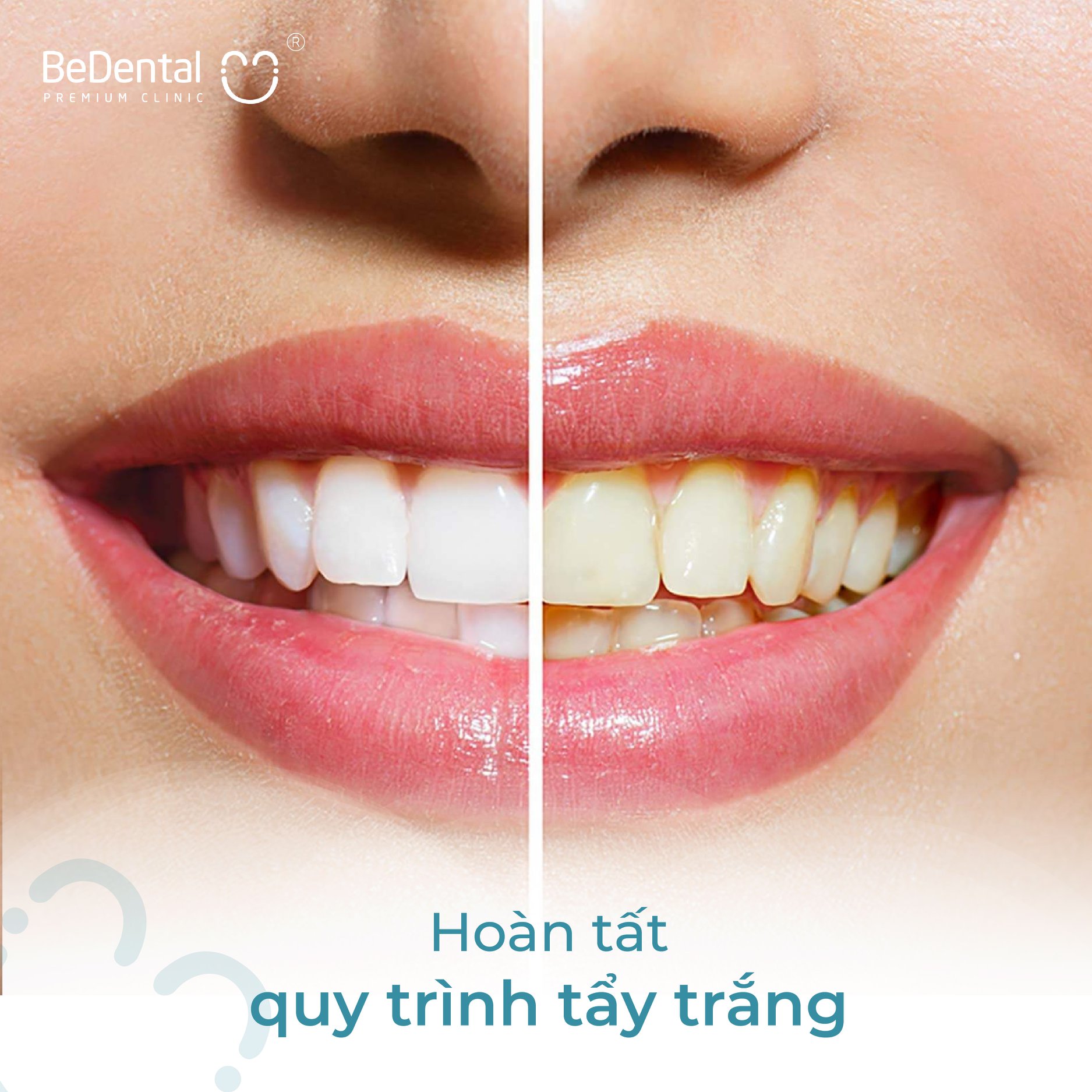 Tẩy trắng răng phương pháp Laser Whitening 5P - Nha khoa BeDental (5 chi nhánh)