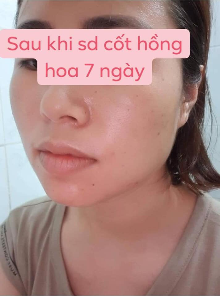 Kem giảm mụn, thâm cốt hồng hoa Rova (combo 2 lọ)