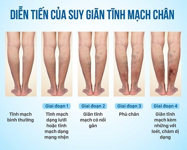 Kem chống suy giãn tĩnh mạch, tinh chất thảo dược thiên nhiên.