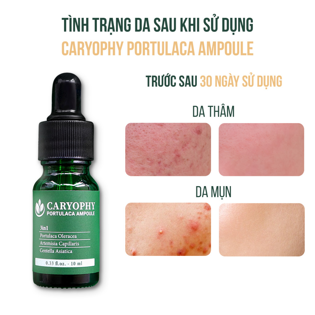 Combo 2 Sản Phẩm Ngừa Mụn, Mờ Thâm, Bảo Vệ Da CARYOPHY (Serum 10ml + KCN Tone Up 50ml)