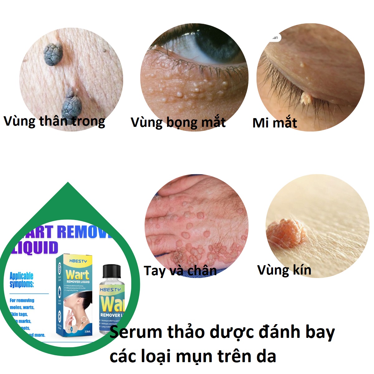 Serum da liễu bôi mụn thịt, mụn cơm, mụn cóc, nốt ruồi, thành phần thảo dược an toàn giá rẻ_HBESTY