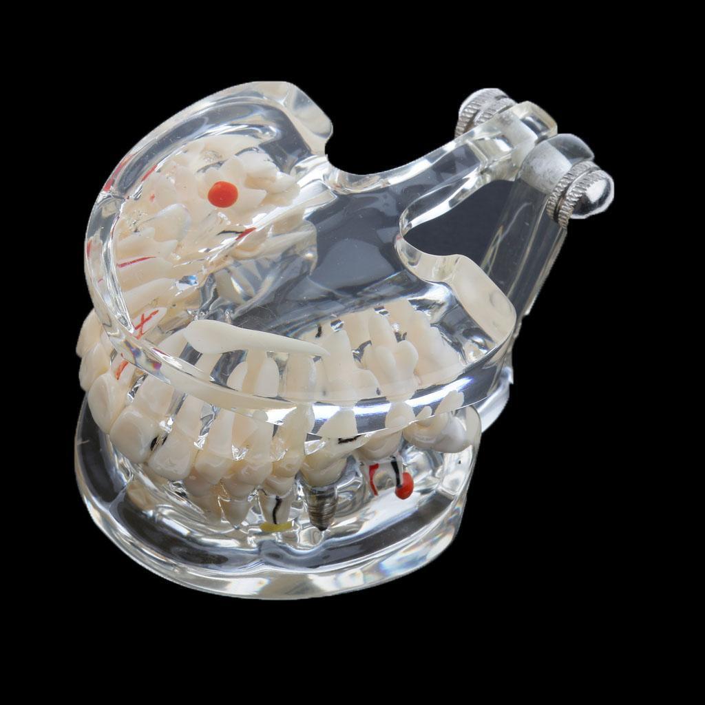 Dental Implant Disease Teeth Model Dentist Removable Tooth Model Tool Clear