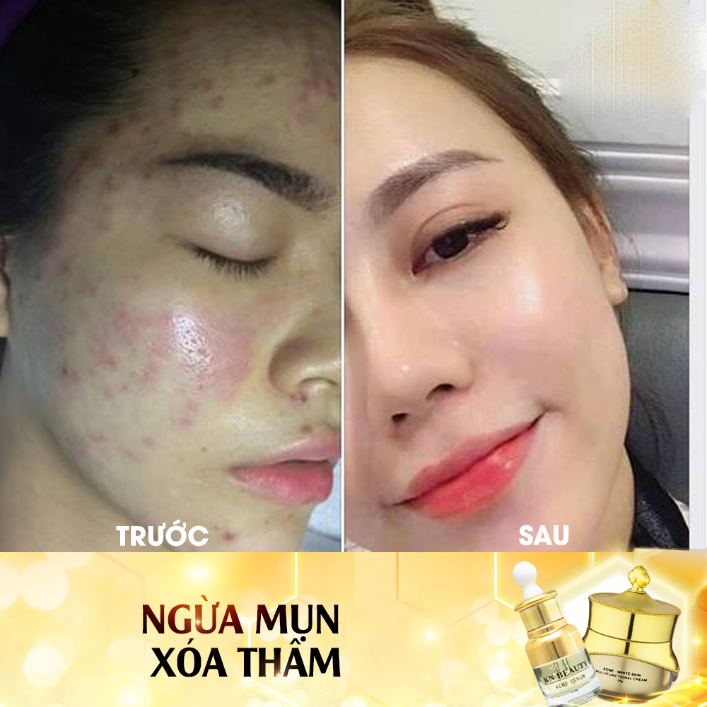 Bộ 2 sản phẩm Trắng Da Ngừa mụn KN Beauty chuyên sâu: Kem dưỡng 25g + Serum 30ml - Quà Tặng Mặt Nạ