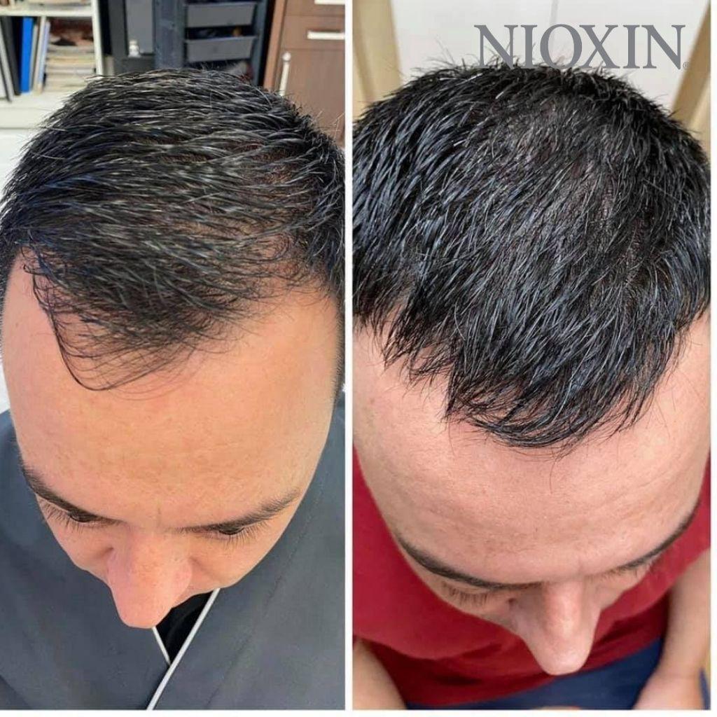 Bộ Chăm Sóc Tóc Nioxin 5 Dành Cho Tóc Tạo Kiểu, Thưa Mỏng, Rụng Nhẹ Bleached/Chemically Treated Hair With Light Thinning