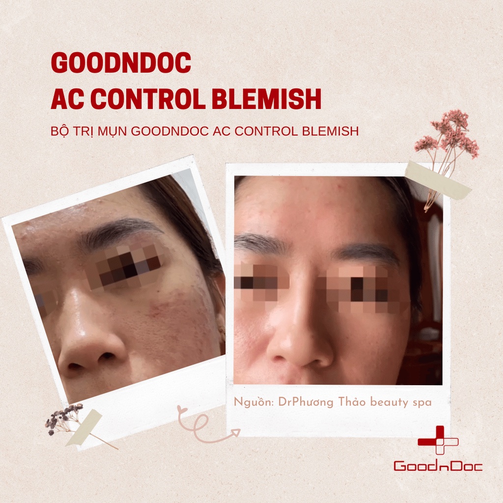 Bộ Sản Phẩm Chăm Sóc Chuyên Sâu Cho Da Mụn GoodnDoc AC Control Blemish