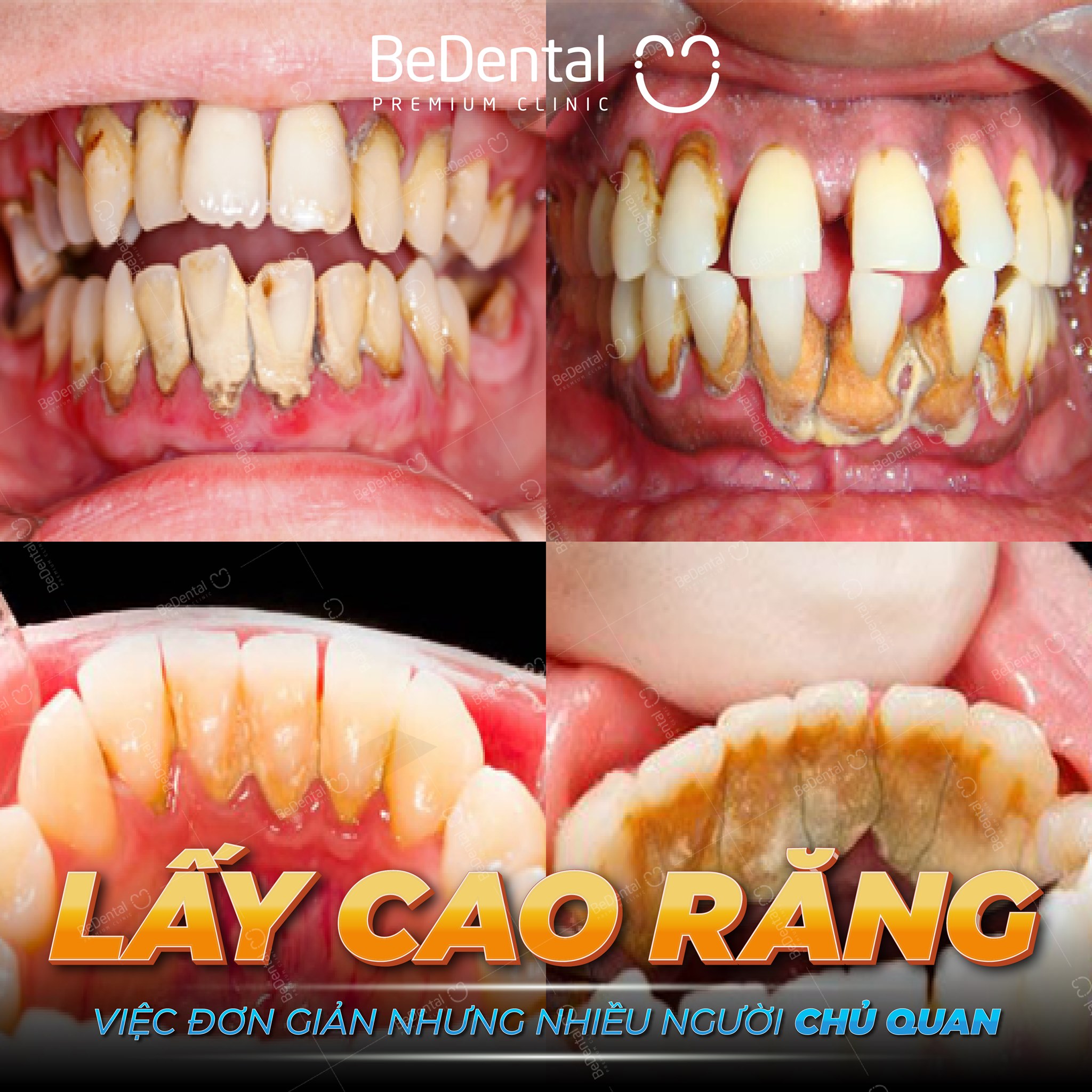 Lấy Cao Răng (Cạo vôi răng) Và Đánh Bóng Công Nghệ Siêu Âm Mới - Nha khoa BeDental (5 chi nhánh)