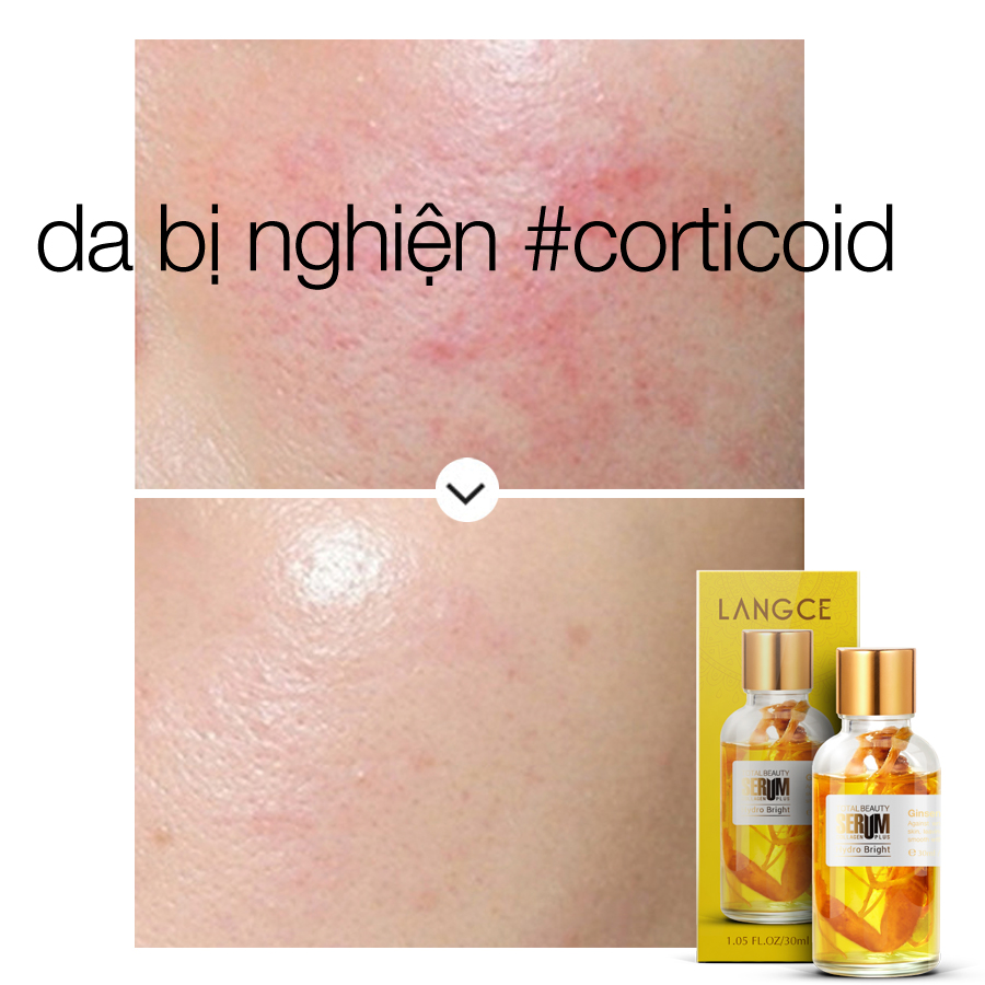 SERUM SÂM GIẢM MẪN ĐỎ, CHỐNG VIÊM TĂNG CƯỜNG KHẢ NĂNG MIỄN DỊCH CHO DA 30ml LANGCE dành cho Nam