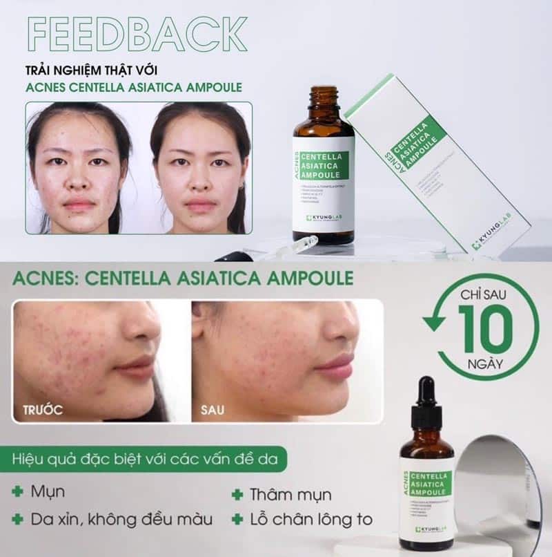 Serum trị mụn Kyung Lab Acnes Centella Asiatica Ampoule 50ml