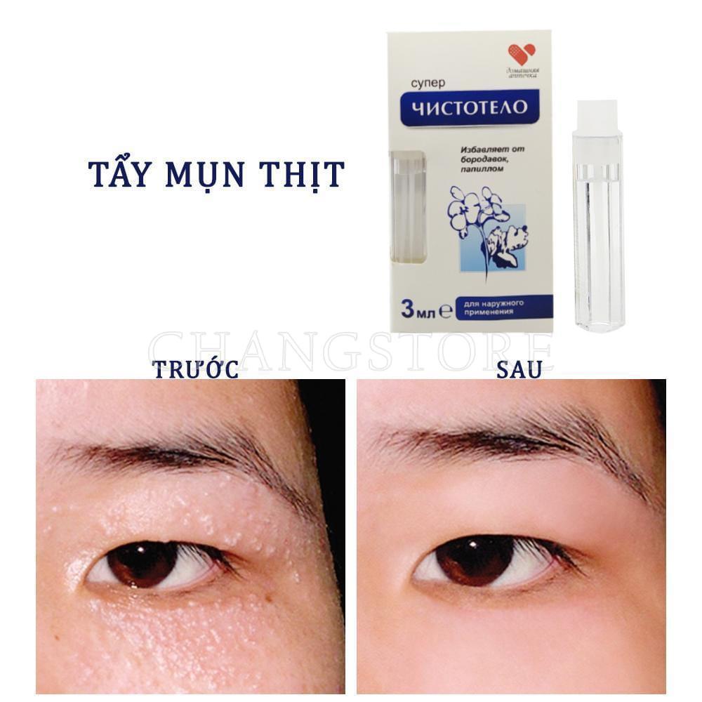 Gel tẩy nốt ruồi, mụn cóc, mụn thịt, tàn nhang, sẹo lồi Develinil của Nga