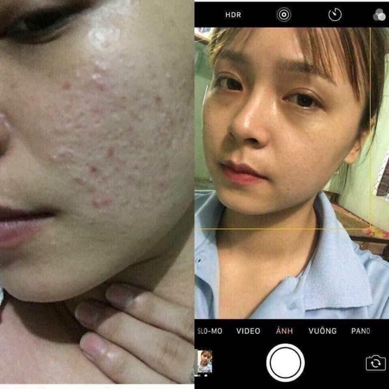 Kem Ngăn Ngừa Mụn Acne DR CELL 30g