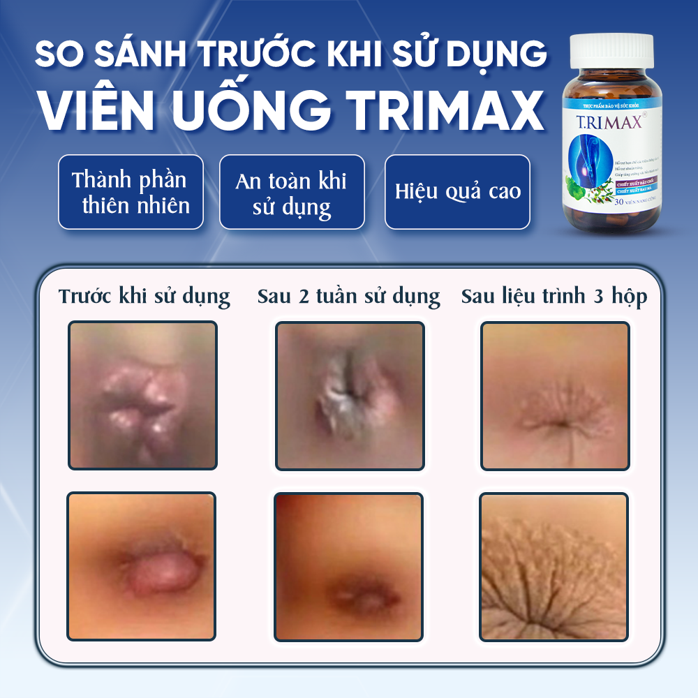 Viên Uống Hỗ Trợ Co Thắt Búi Trĩ Trimax Hủ 30 Viên Nguyên Liệu Từ Thiên Nhiên