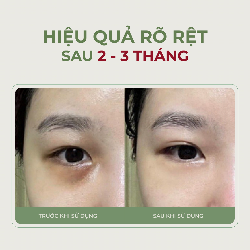 [COMBO 3] Kem Mắt Abera 15ml - Giúp Giảm Thâm Mắt, Bọng mắt, Nếp Nhăn, Làm Trắng Sáng Da Vùng Mắt