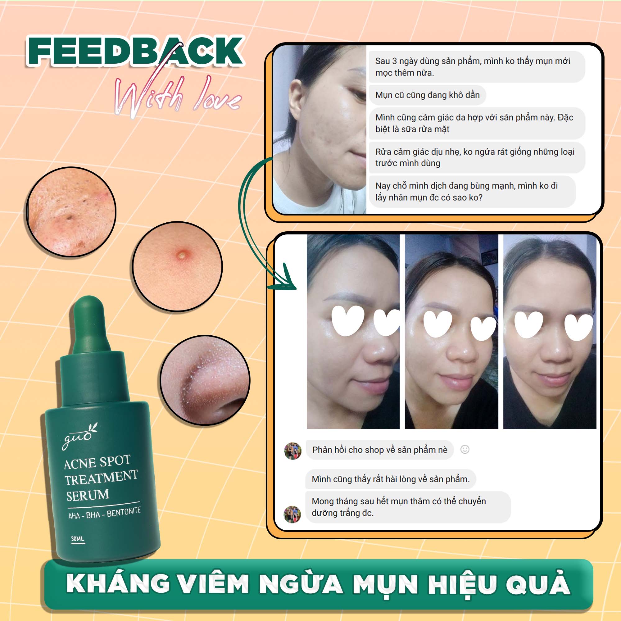 Tinh chất Serum Sạch Mụn Mờ Thâm Gom Mụn cho bà bầu GUO 30ml