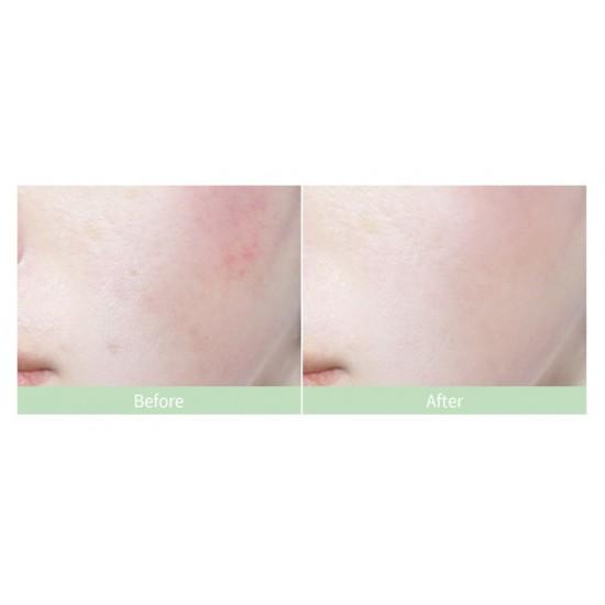 Serum Giảm Mụn, Giảm Thâm Mụn Caryophy 3in1