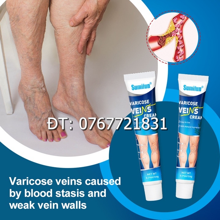 Gel bôi hỗ trợ nhức xương khớp, suy giãn tĩnh mạch, đau nhức khớp gối, phù chân, tê bì chân tay, thiếu chất nhầy khớp gối, khô khớp, thoát vị đĩa đệm xuất xứ Malaysia - Mã số 1365