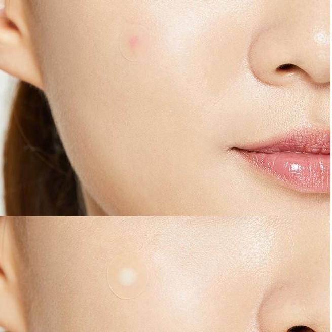 Combo 2 Miếng Dán Mụn COSRX Acne Pimple Master Patch