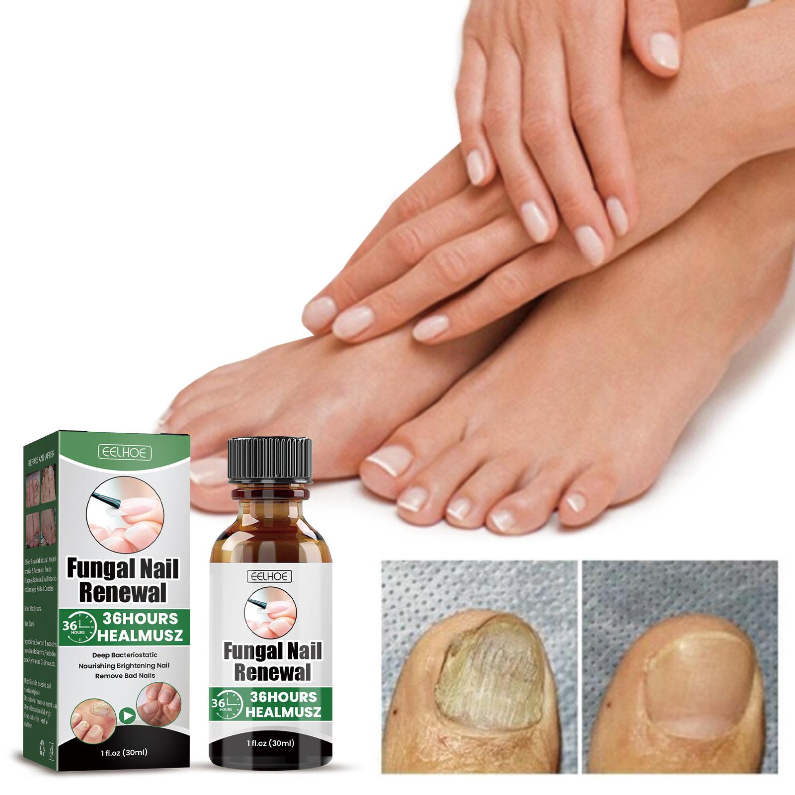EELHOE 30ml Nail Treatment Essence for Onychomycosis Mild Non-irritating Nail Bright Shiny Repair Nail Repair Solution