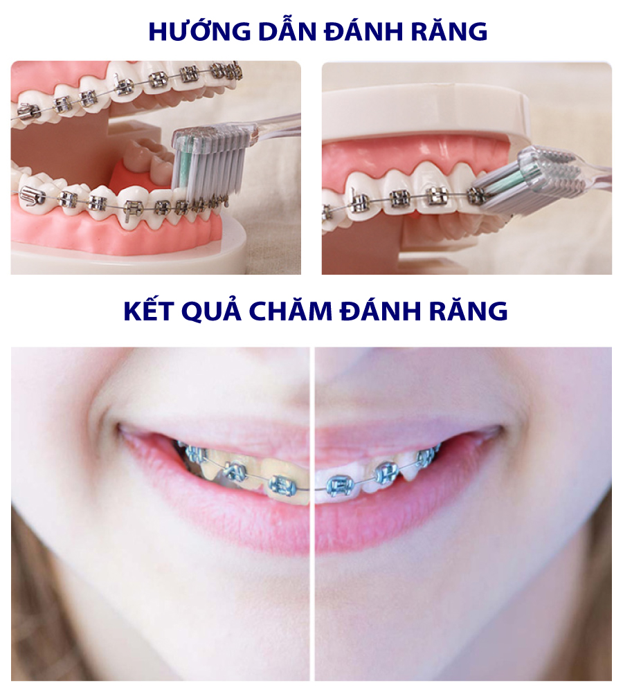 Bàn Chải Đánh Răng Dành Cho Răng Niềng Trisa Bracket Clean