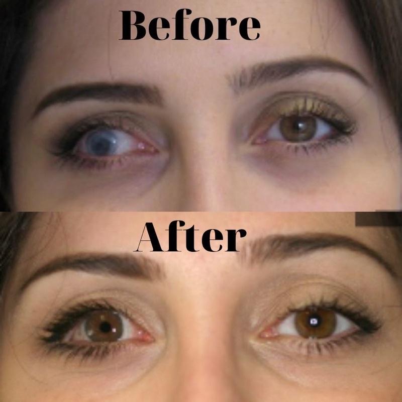 Lens Thẩm Mỹ Kính Áp Tròng Che Khuyết Điểm Cho Mắt Hỏng, Cườm, Đục Thuỷ Tinh Thể, Kéo Mây - FAIRY SHOP CONTACT LENS
