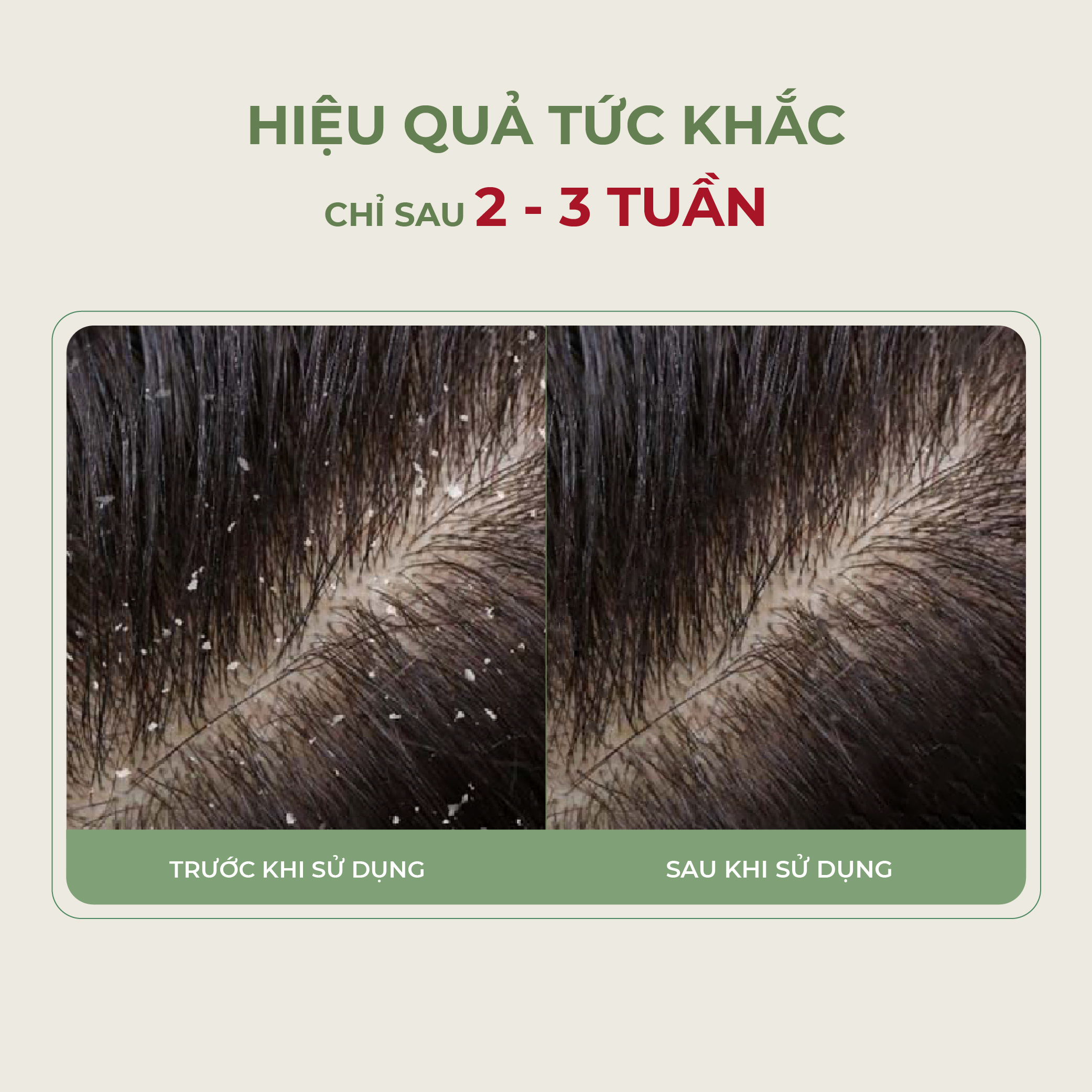 Dầu Gội Amanda Abera Xử Lý Nhanh Tình Trạng Gàu, Ngứa, Nấm Da Đầu Với Hương Thơm Nam Tính, Quyến Rũ - 200ml