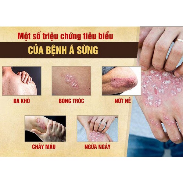 Kem bôi da liễu đông y -Nấm ngứa, tổ đỉa, hắc lào, lang ben, vảy nến, á sừng, zona các vấn đề về da