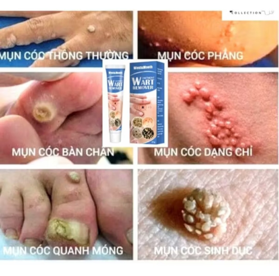 HỘP KEM TRỊ HẾT MỤN CÓC NÚT RUỒI DA NÁM SẠM