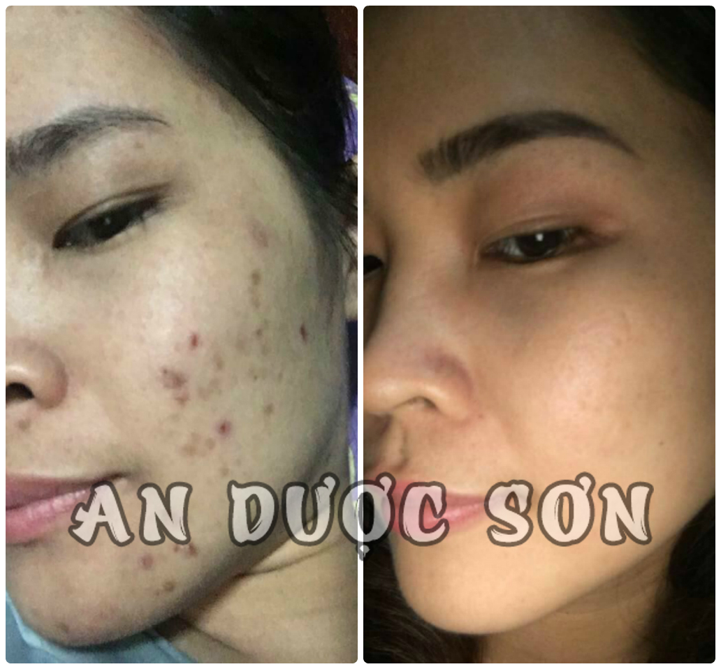 Serum ngừa mụn thâm sẹo rỗ An Dược Sơn 50ml & Bột rửa mặt an dược sơn