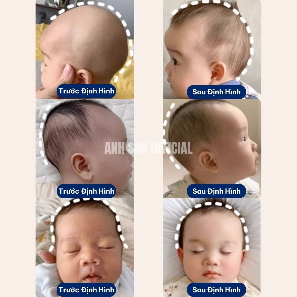 Gối Định Hình Đầu Cho Bé Sơ Sinh Cao Cấp Ánh Sao Chắc Chắn Có Khoá Dán Hỗ Trợ Đầu Cổ Thoáng Khí
