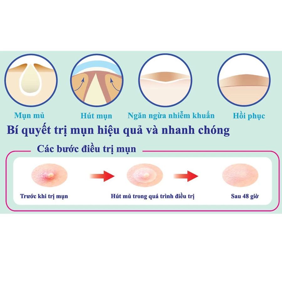 Combo 5 Miếng Dán hỗ trợ điều trị Mụn Mayancare 12 Miếng