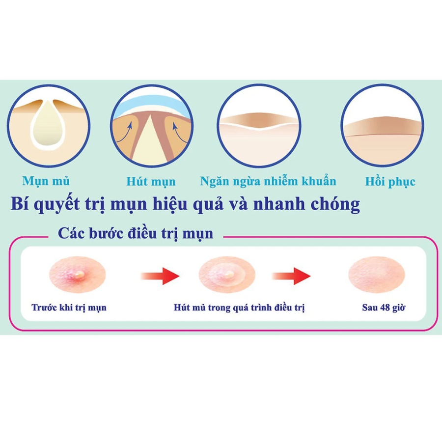 Combo 5 Miếng Dán hỗ trợ điều trị Mụn Mayancare 12 Miếng (1.0cm)