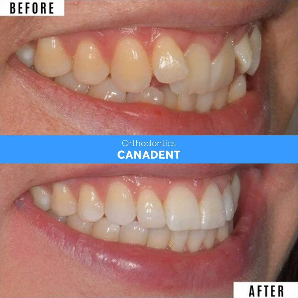 BỘ 3 NIỀNG RĂNG SILICON CANADENT ALIGNMENT.