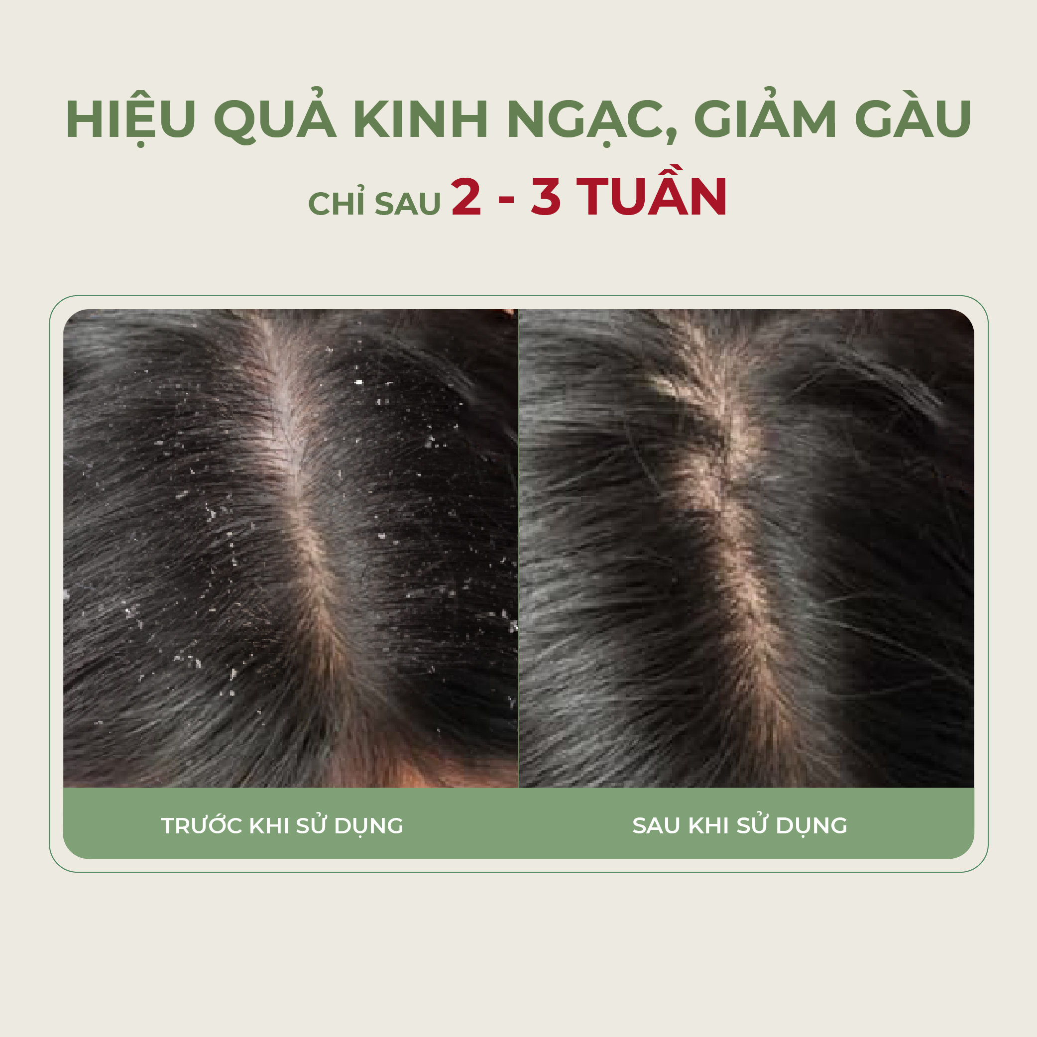 Serum Vera Abera Xử Lý Nhanh Tình Trạng Gàu, Ngứa, Nấm Da Đầu 20ml