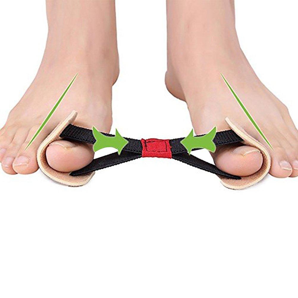 Hallux valgus bunion búi ngón chân lớn