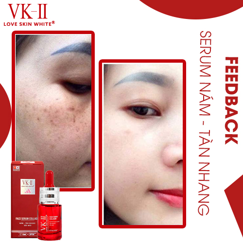 Serum Ngừa Nám Tàn Nhang Đồi Mồi VK II