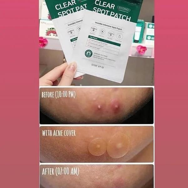 Combo 2 Miếng Dán Hỗ Trợ Giảm Mụn Some By Mi Clea.r Spot Patch x 2