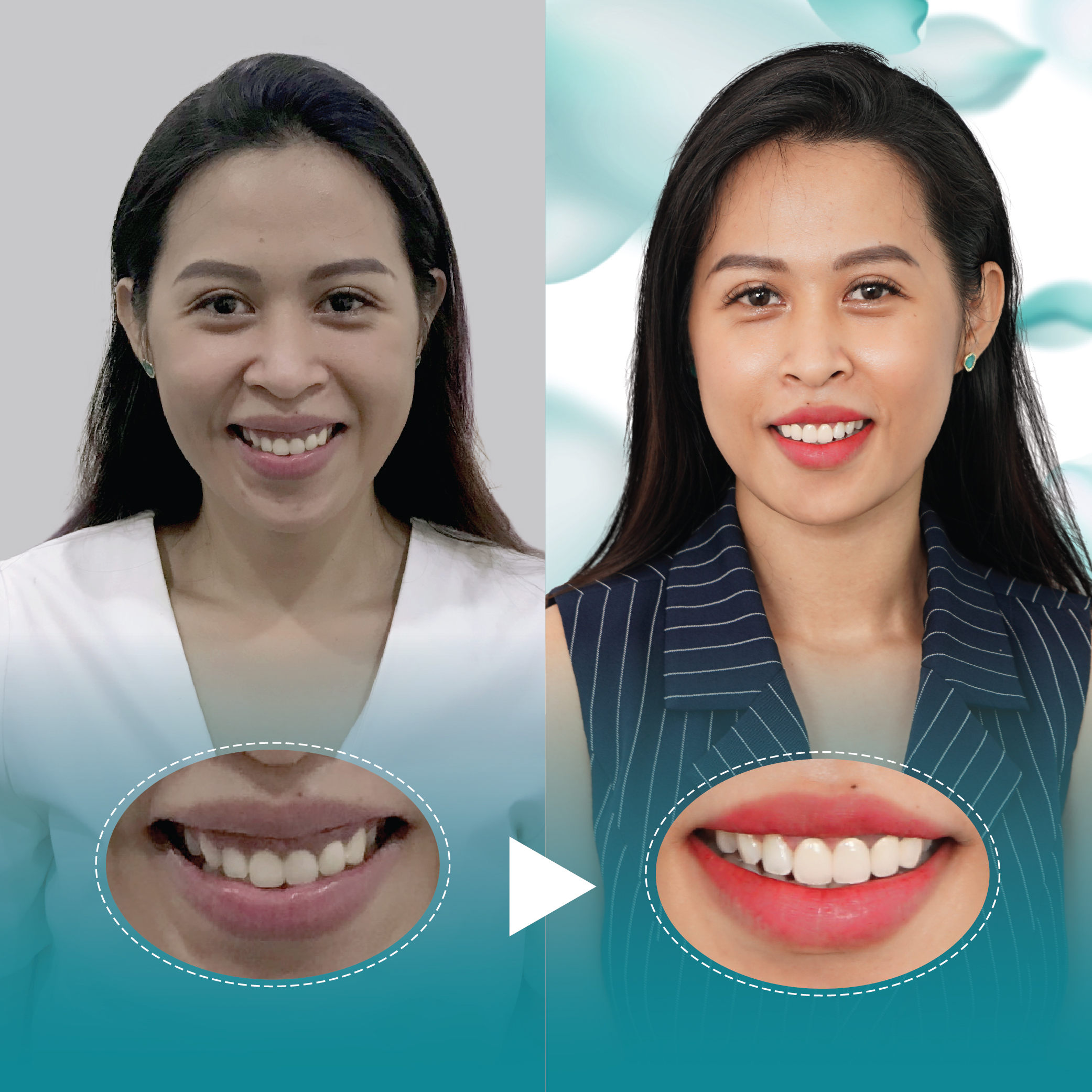 Điều trị dứt điểm hở lợi tại Nha Khoa Thẩm Mỹ Quốc Tế San Dentist