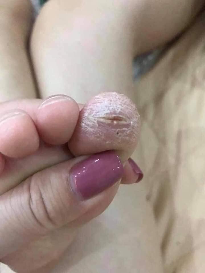 Kem Bôi Nứt Nẻ Á Sừng Tay Chân Ngoài Da - Hàng Nhập Khẩu