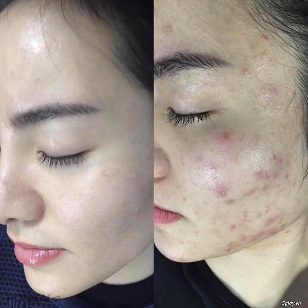 Kem mụn Acne Cream IRC mụn cám, mụn ẩn tăng sinh collagen phục hồi da mụn 10g