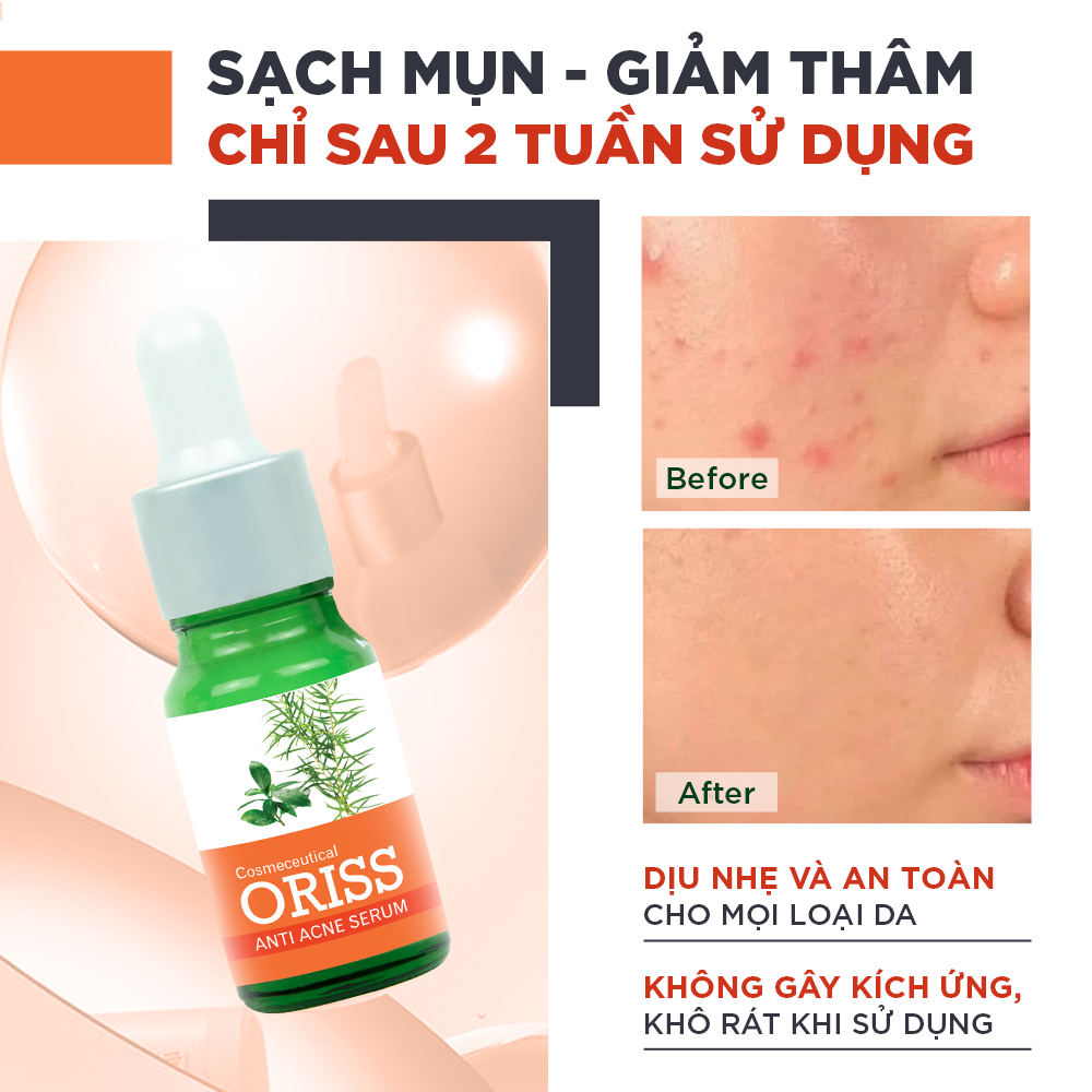 Serum Ngừa Mụn Dưỡng Trắng Da Oriss Cao Cấp