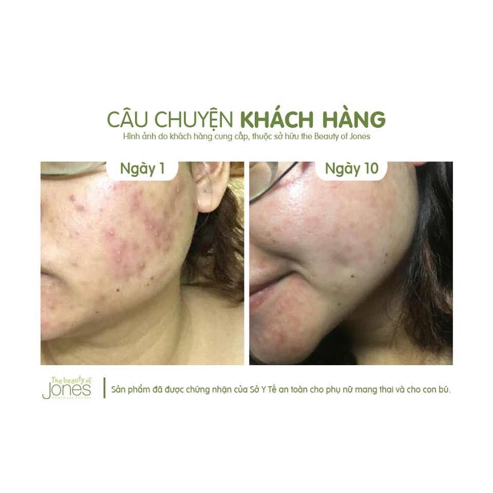 Bộ 2 sản phẩm làm sạch và giảm dầu ngừa mụn The Beauty of Jones