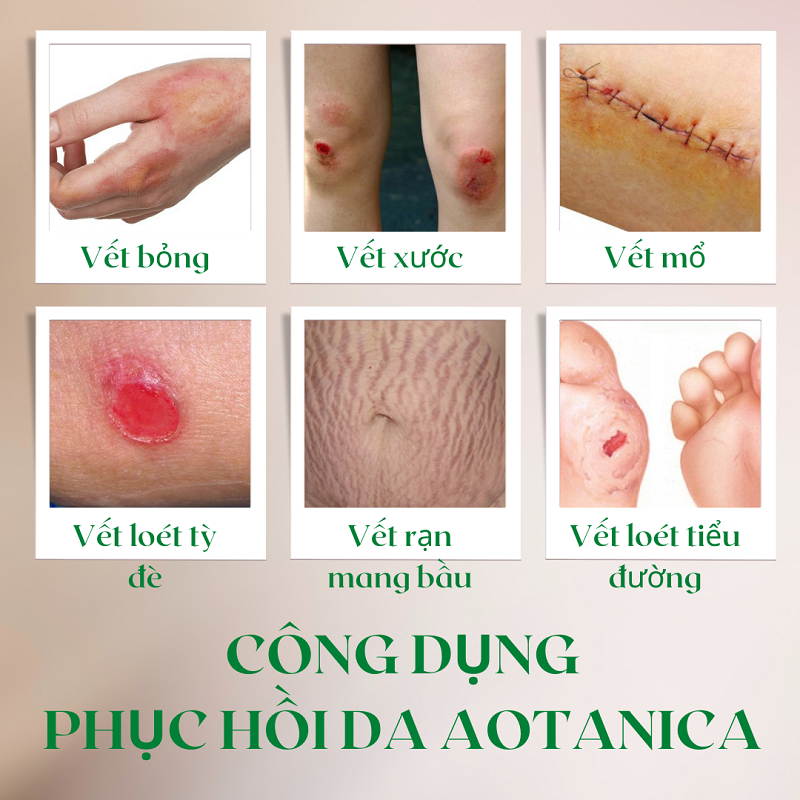 Dầu phục hồi da bỏng &amp; vết thương hở Aotanica 20ml