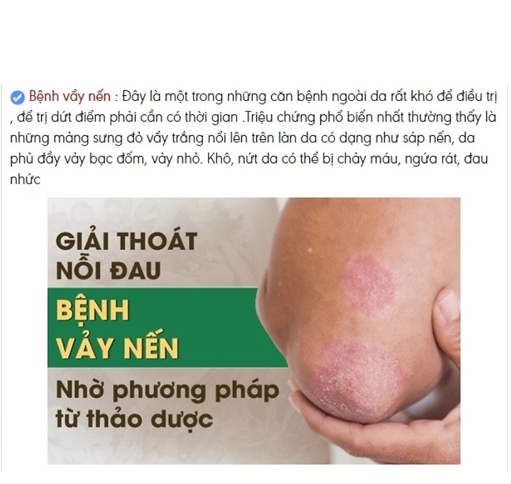 KEM BÔI DA LIỄU ĐÔNG Y-Nấm ngứa, tổ đỉa, hắc lào, lang men, vẩy nến, á sừng, zona các vấn đề về da