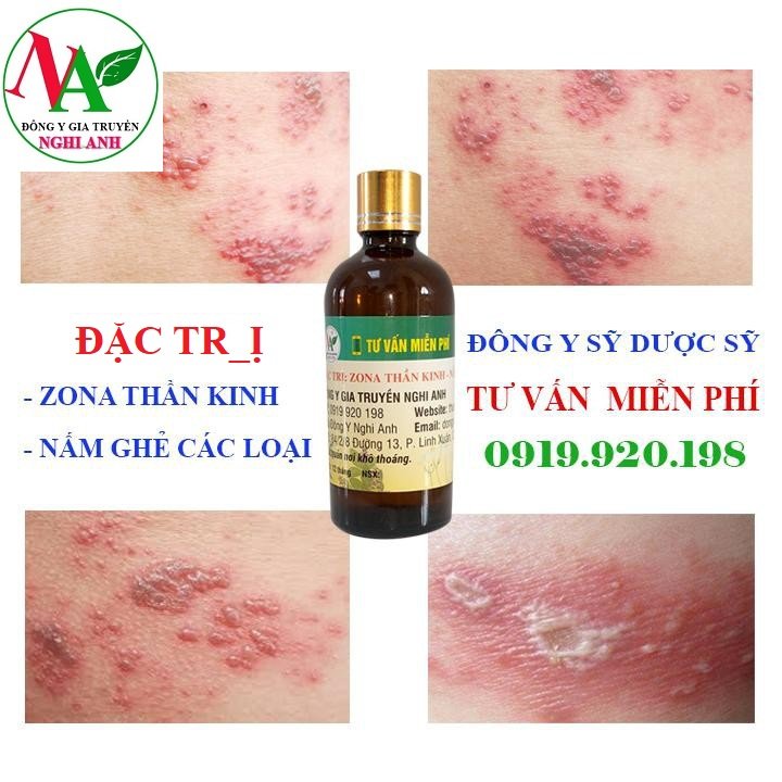 Lọ 100ml Thảo dược bôi zona thần kinh, nấm ghẻ, ngứa dị ứng hiệu quả Đông Y Nghi Anh