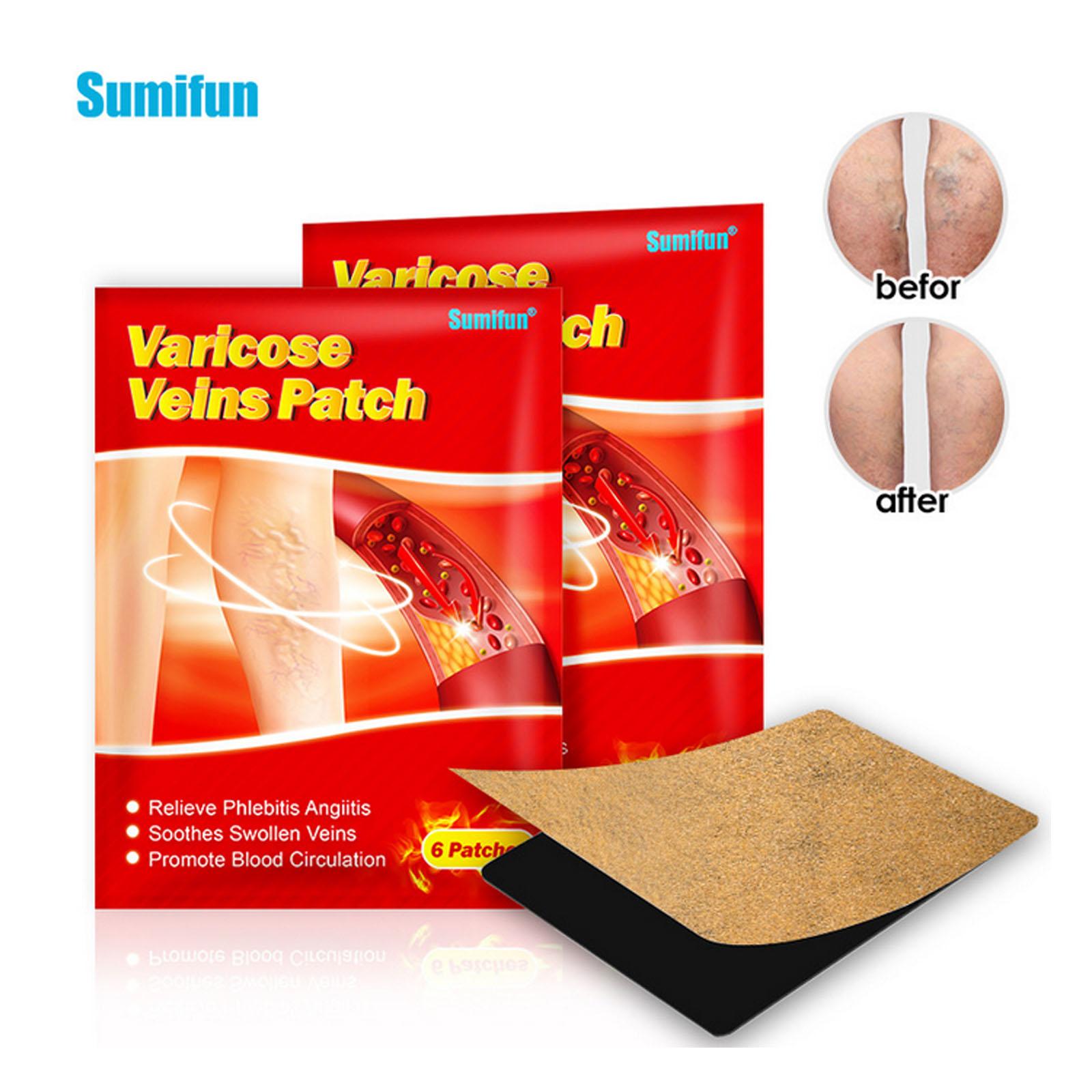 Vein ointment patch Vein curvature posting ointment patch for external use on legs