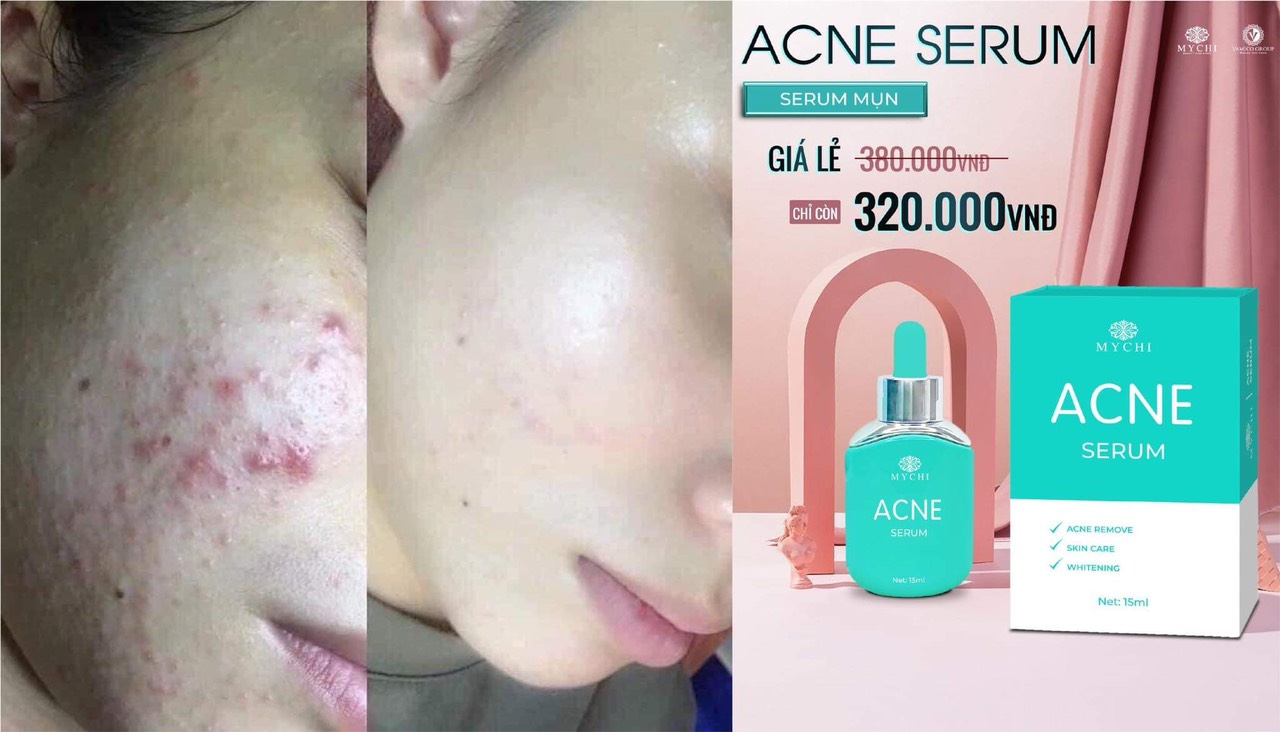 Serum mụn ACNE Mychi