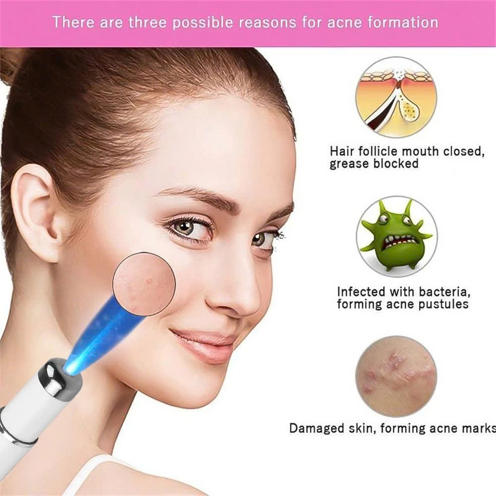 Máy LASER tẩy mụn và xóa sẹo với ánh sáng xanh thần kỳ: Giải pháp thông minh an toàn