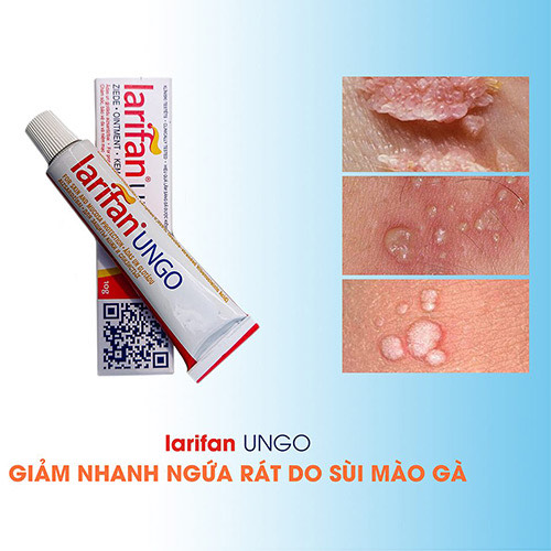 Kem bôi Larifan Ungo ngăn ngừa mụn rộp, sùi mào gà, Herpes 10g xuất xứ Châu Âu - Anh Khuê Pharma