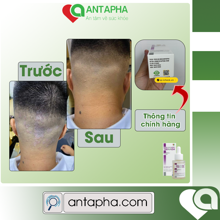 Serum Trinada nấm da đầu, gàu ngứa sạch sẽ da đầu, Antapha