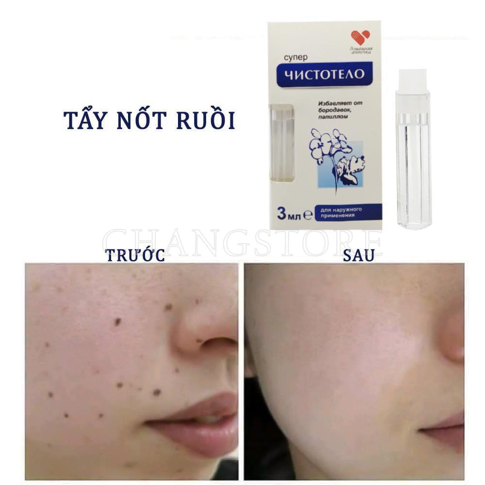 Gel tẩy nốt ruồi, mụn cóc, mụn thịt, tàn nhang, sẹo lồi Develinil của Nga