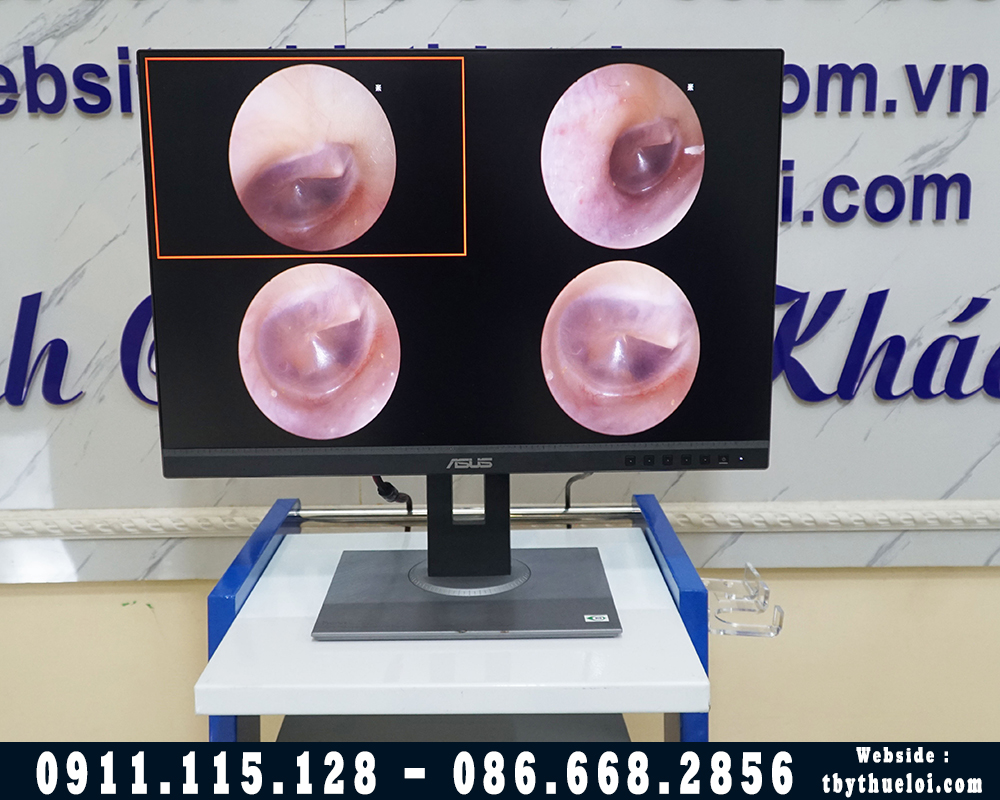 Máy Nội Soi Tai Mũi Họng FULL HD - FHD 180 - Hình Ảnh Sắc Nét Có Kèm Màn Hình Mini 7ich,Kèm 2 optic tùy chọn